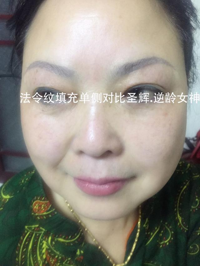 无针微整加盟哪家好？圣辉.逆龄女神无针微整是佳选