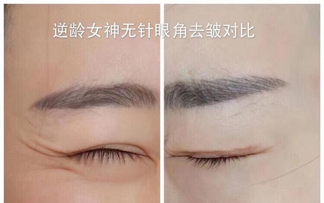 无针微整加盟哪家好？圣辉.逆龄女神无针微整是佳选