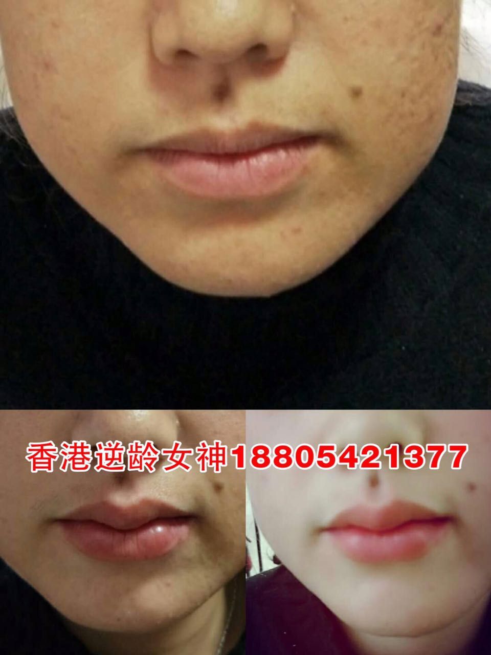 无针微整加盟哪家好？圣辉.逆龄女神无针微整是佳选