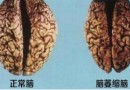 家里老人得了脑萎缩不要怕，“五龙营养复原汤”克星！